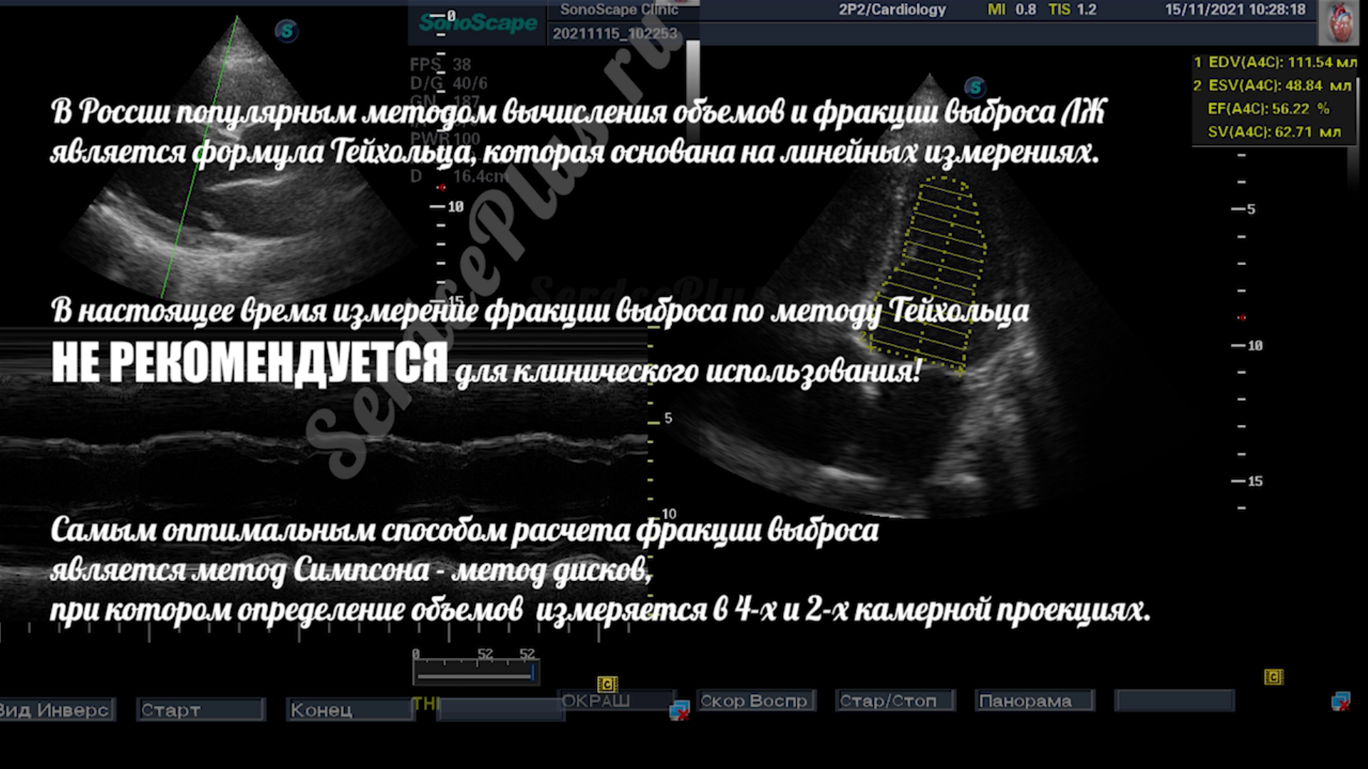 Почему измерение ФВ по Тейхольц не рекомендовано?
