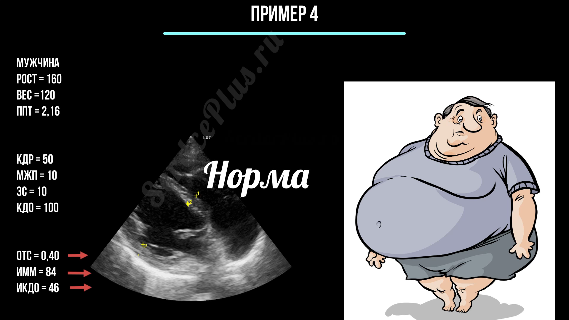 Гипертрофия левого желудочка. Заключение эхокардиографии
