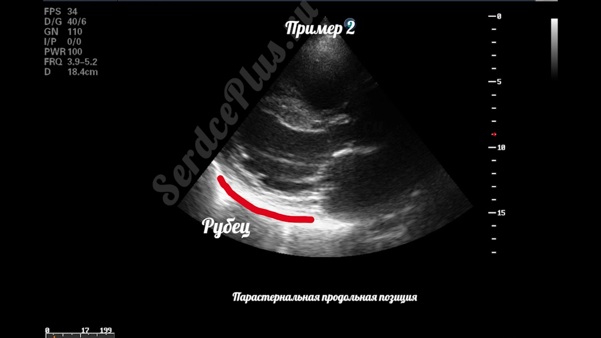 Почему измерение ФВ по Тейхольц не рекомендовано?