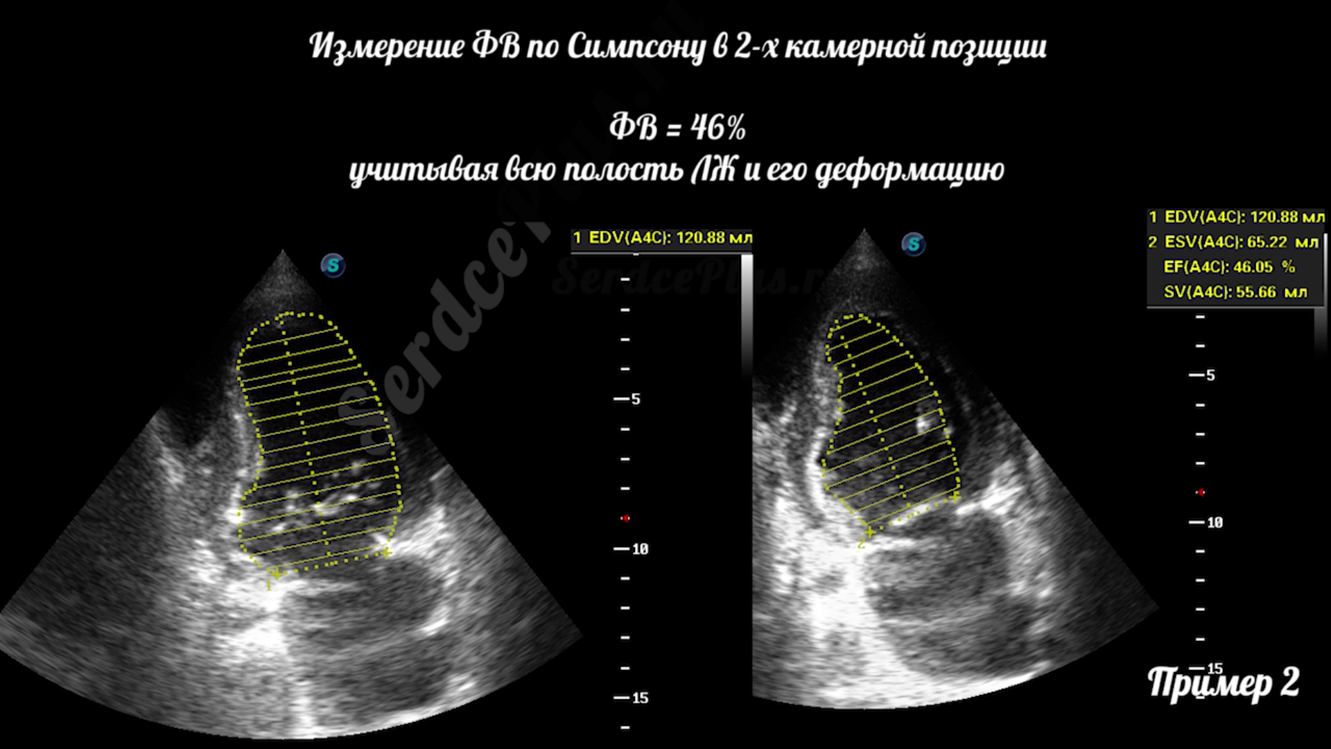 Почему измерение ФВ по Тейхольц не рекомендовано?