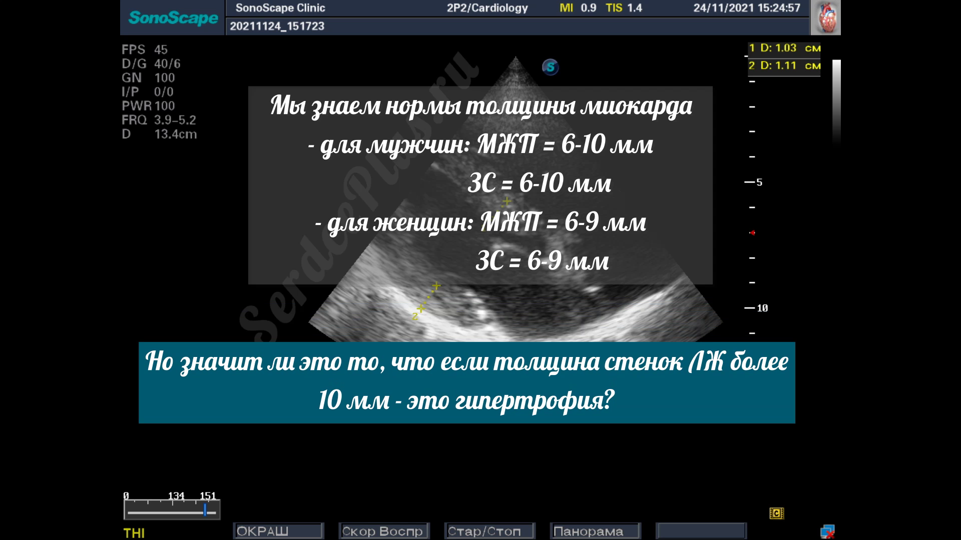 Гипертрофия левого желудочка. Заключение эхокардиографии