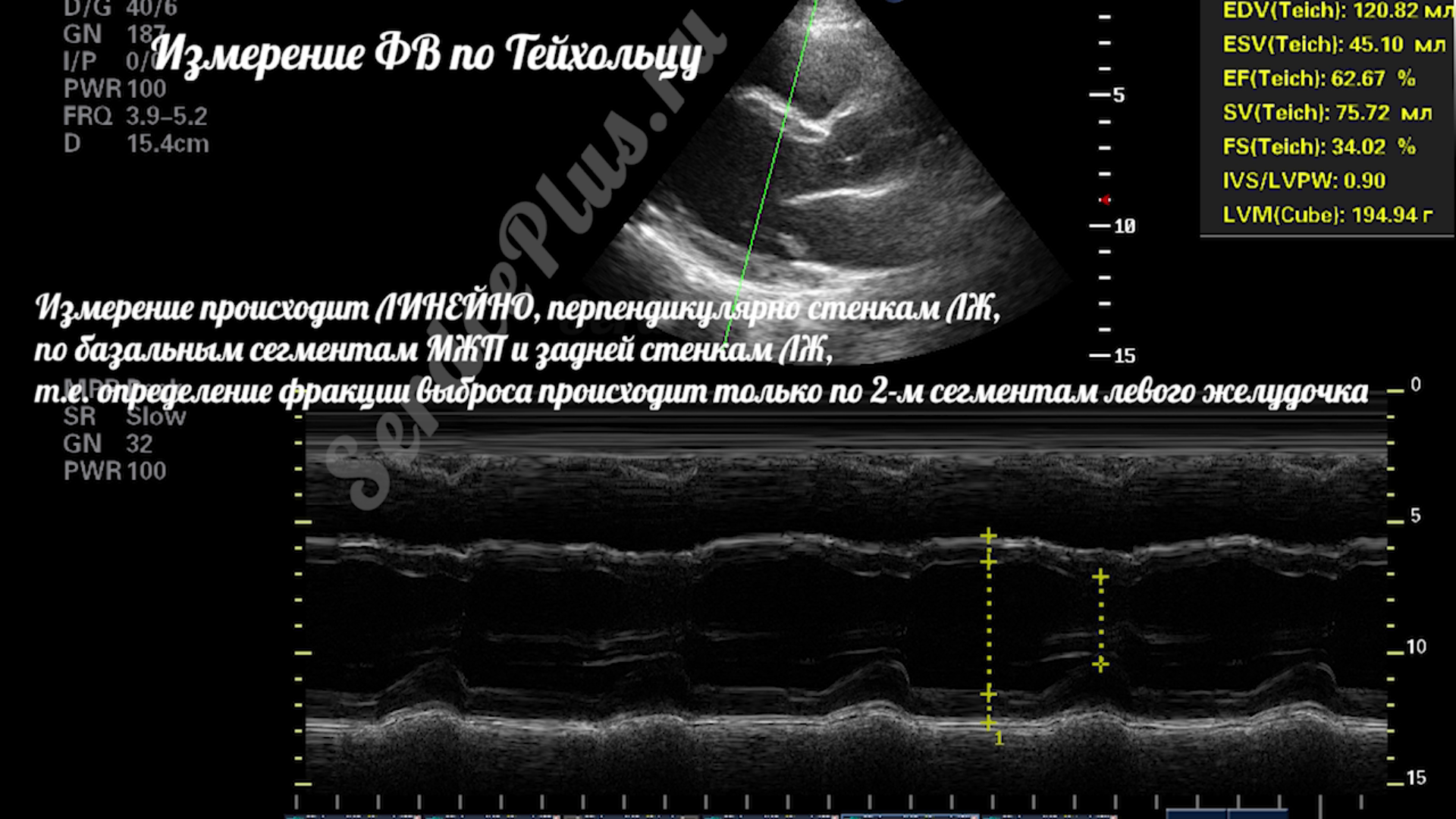 Почему измерение ФВ по Тейхольц не рекомендовано?
