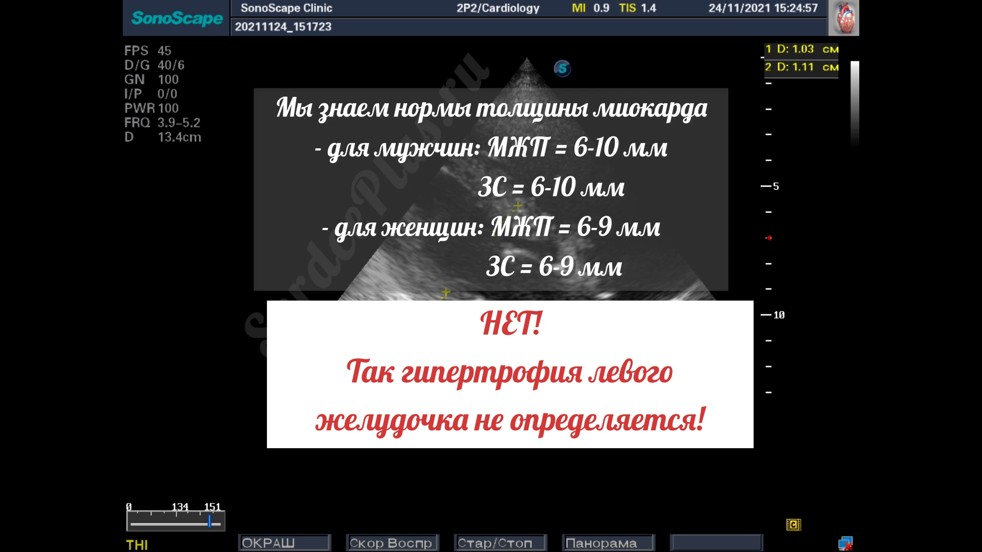 Гипертрофия левого желудочка. Заключение эхокардиографии