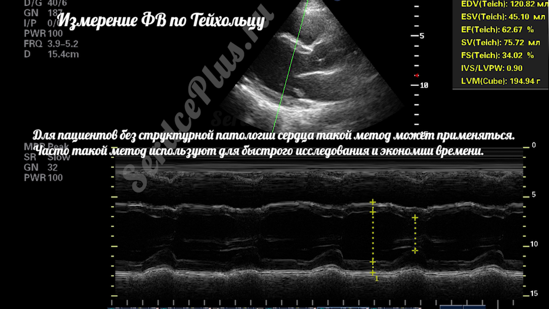Почему измерение ФВ по Тейхольц не рекомендовано?