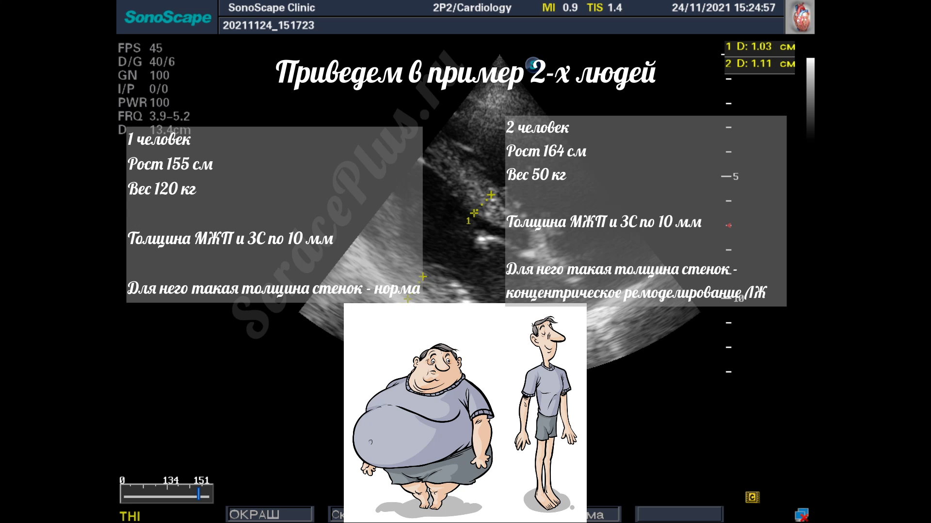 Гипертрофия левого желудочка. Заключение эхокардиографии