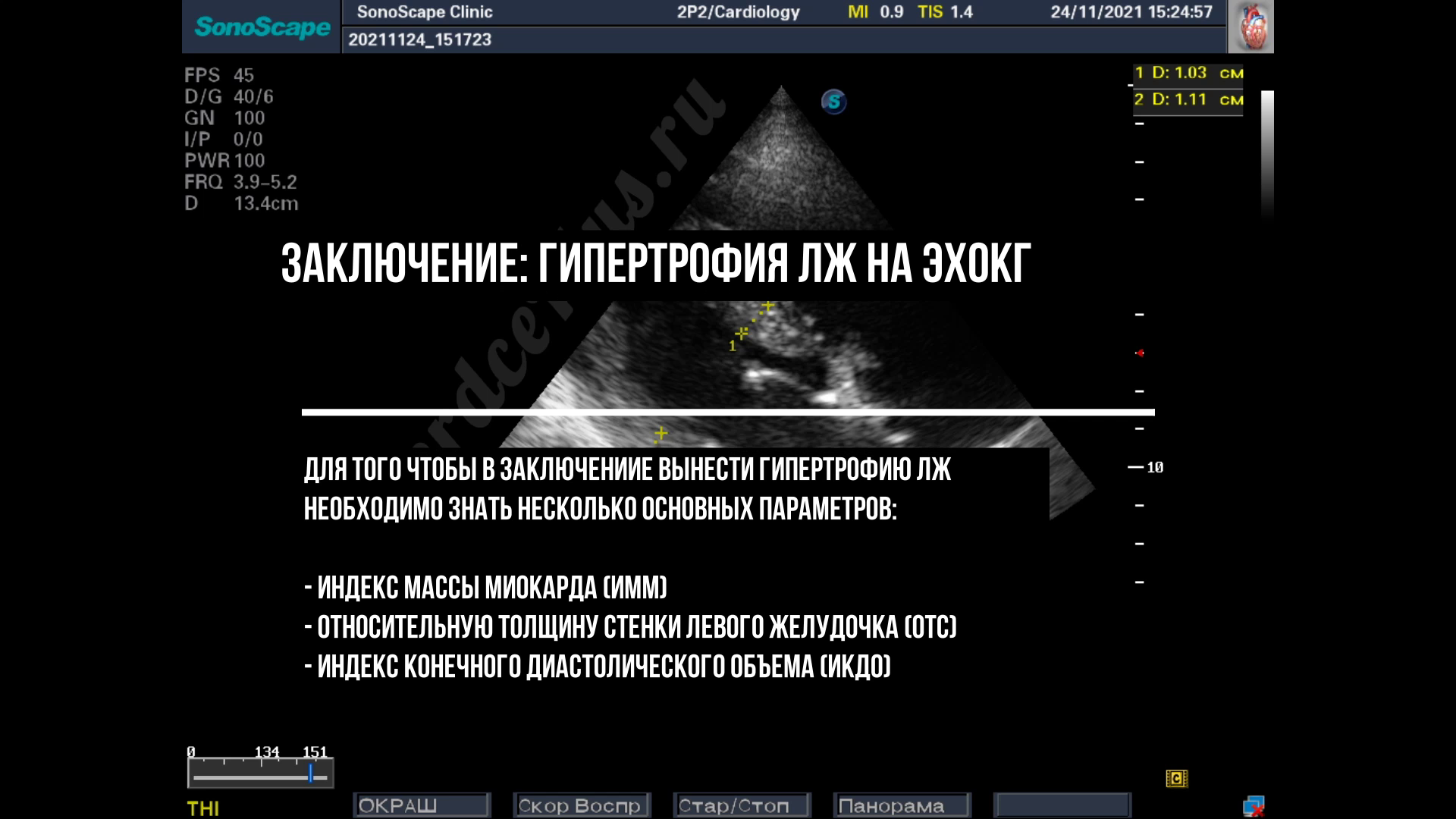 Гипертрофия левого желудочка. Заключение эхокардиографии