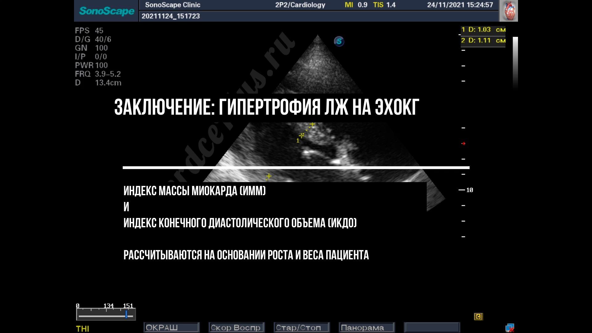 Гипертрофия левого желудочка. Заключение эхокардиографии