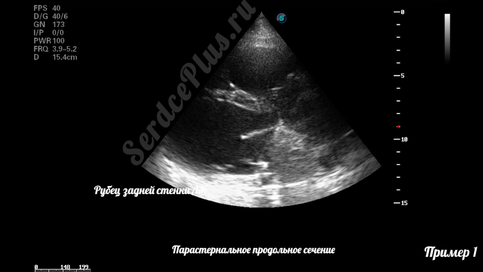 Почему измерение ФВ по Тейхольц не рекомендовано?