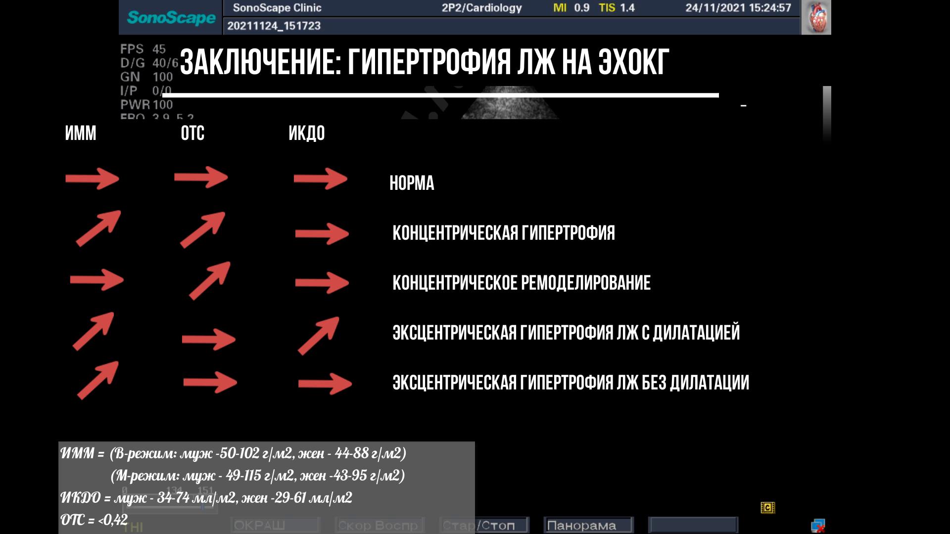 Гипертрофия левого желудочка. Заключение эхокардиографии